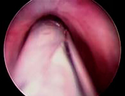 Endoscopic view of a surgical procedure.