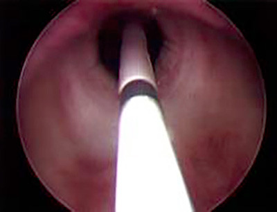 Endoscopic view of the throat.