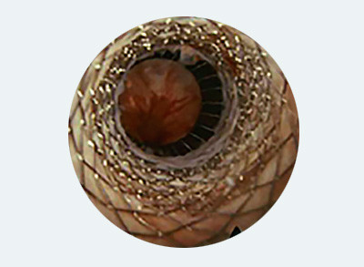 Close-up of an eye with a mesh implant.