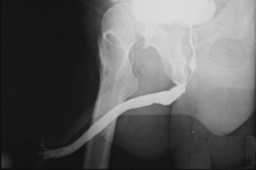 X-ray image of a leg with a stent.