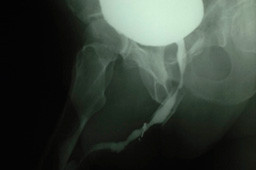 X-ray image of a fractured hip.