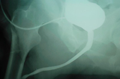 X-ray of a hip joint with a catheter.