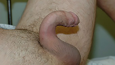 Erect Penis with downward curvature from Peyronie’s Disease
