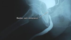 Bladder Neck ContracturesCenter for Reconstructive Urology