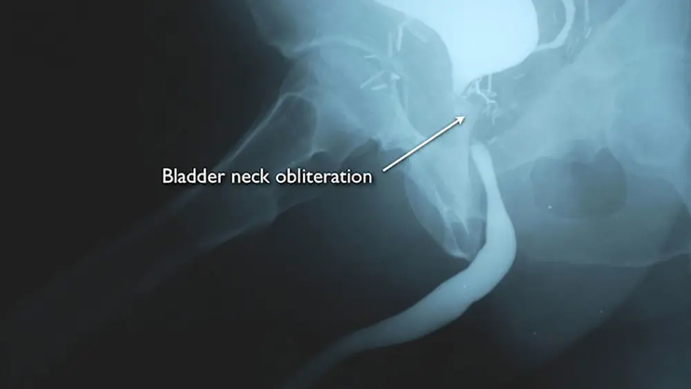 Bladder-neck-obliteration