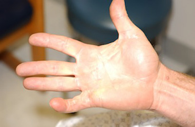 Dupeytren’s Contracture associated with Peyronie’s Disease