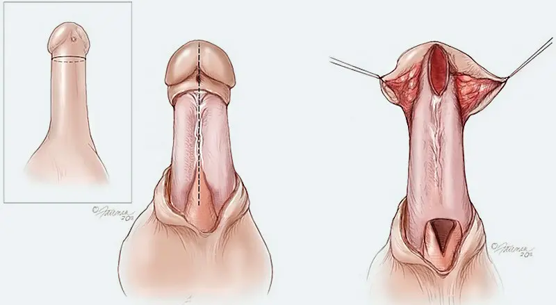 Flap-graft-urethroplasty1_000