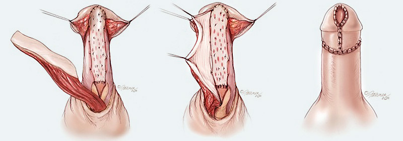 Flapgraft-urethroplasty2