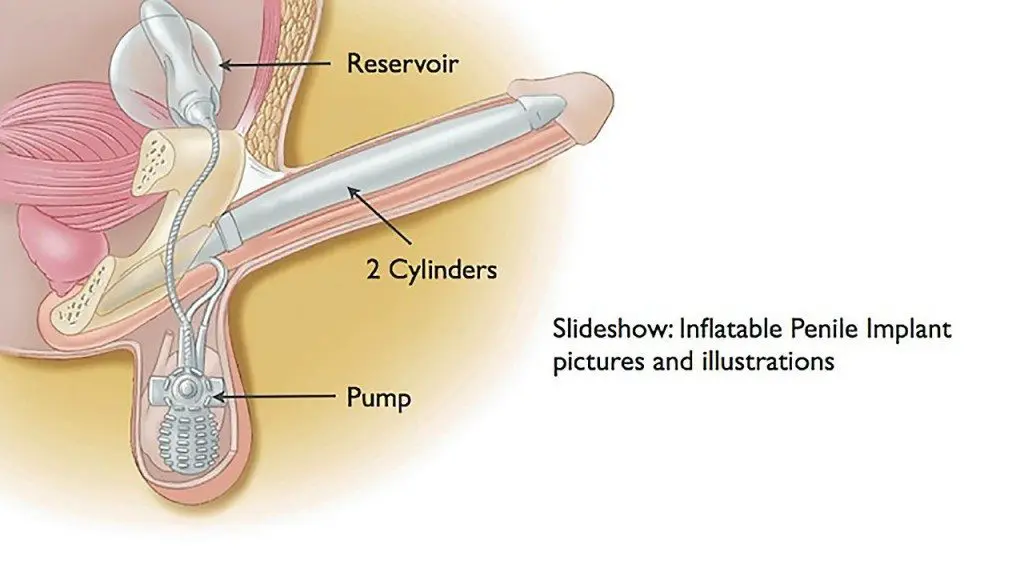 An Inflatable Penile Implant Picture in Color