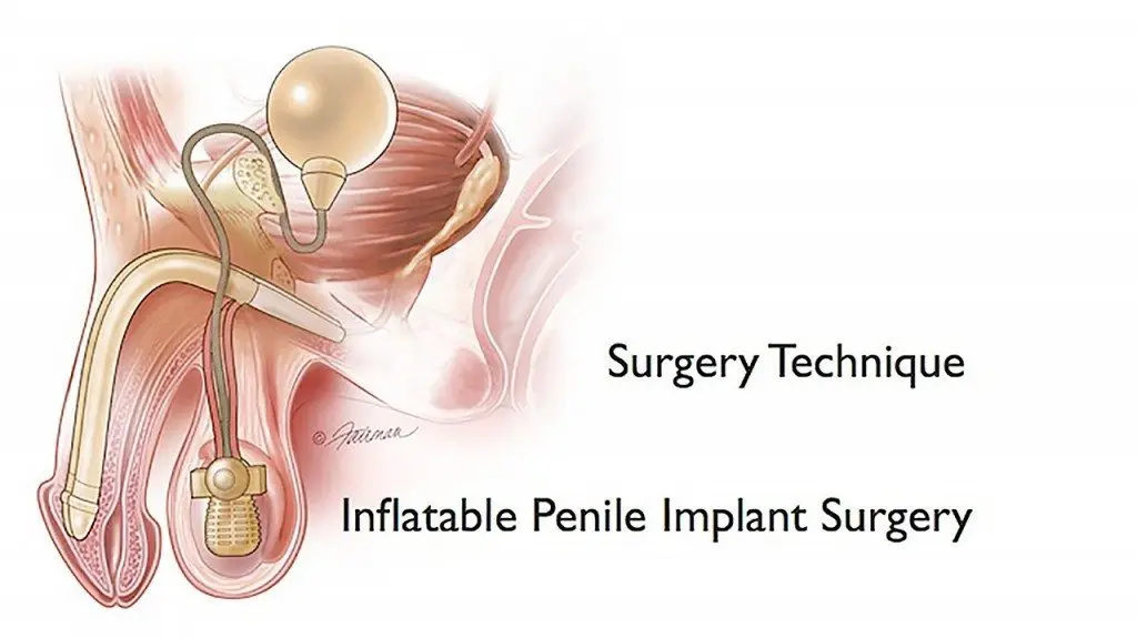 Penile Implant Surgery Image in Color