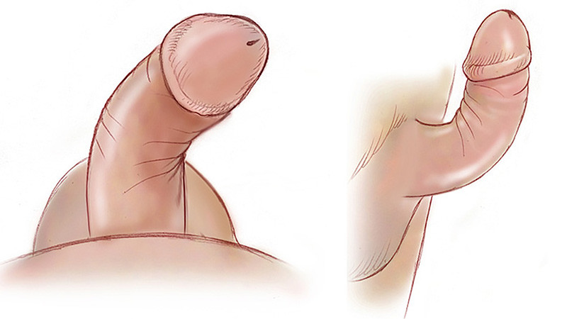 Penis Curvature Image From Different Angels