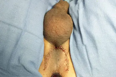 Perineal-Urethrostomy-after-400x265