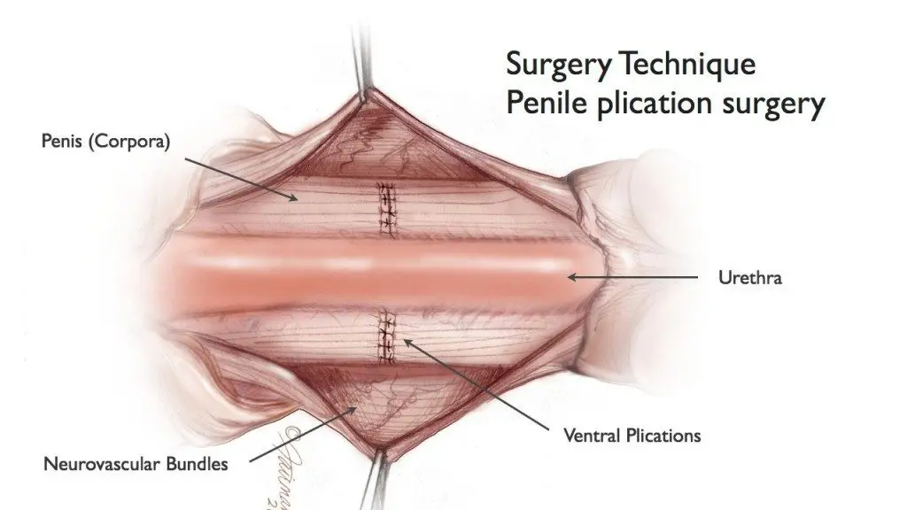 A Diagram in Color of a Surgery Technique