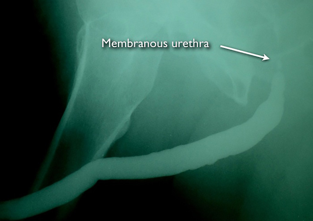 RUG-membranous-stricture