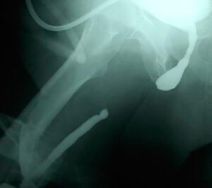 Urethral Stricture Diagnostic Evaluation | World-Renowned Specialist