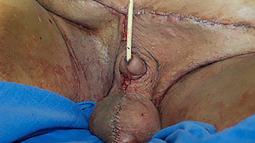 Scrotal-lymphedema-surgery-500x282