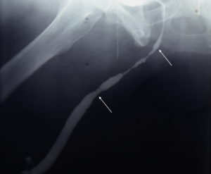 Retrograde Urethrogram demonstrating a 9 cm recurrent stricture