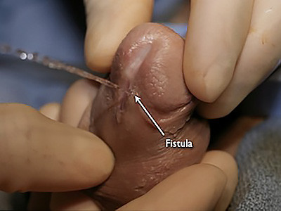 hypospadias-fistula