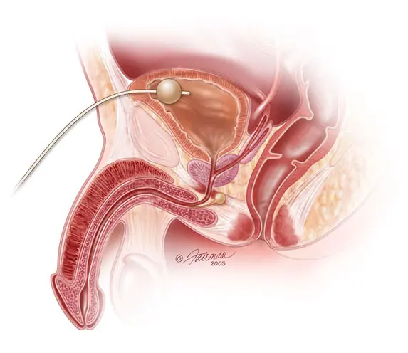 medical-illustration-of-a-suprapubic-tube-inserted-in-bladder