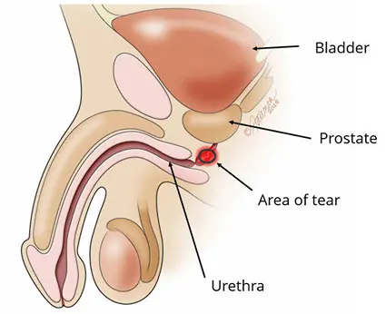 medical-illustration-of-urethral-tear-1