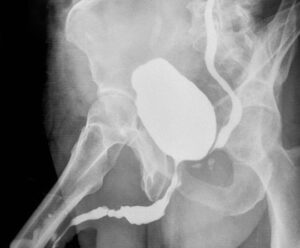 Causes & Symptoms Of Urethral Strictures | World-Renowned Specialist