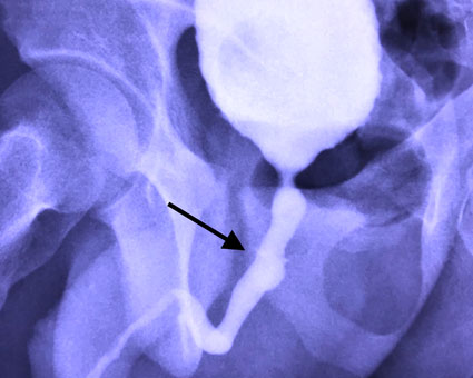 retrograde-urethrogram-after-surgery-to-repair-pelvic-fracture-urethral-injury