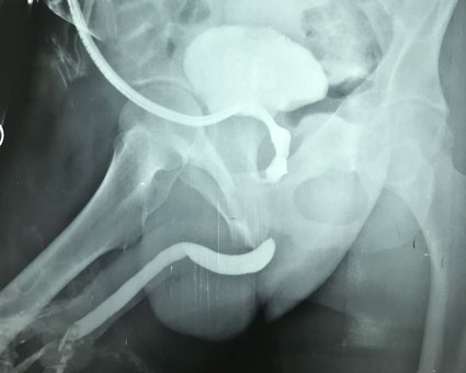 retrograde-urethrogram-prior-to-surgery-to-repair-pelvic-fracture-urethral-injury
