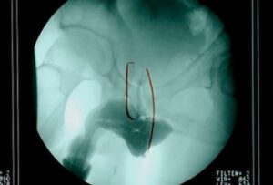 Urethral Stricture Diagnostic Evaluation | World-Renowned Specialist