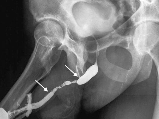 complication of direct vision internal urethrotomy